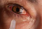Eye Flu: भारत में आई फ्लू 5 तरह से फैल रहा कंजंक्टिवाइटिस, जानिए लक्षण और बचने के उपाय
