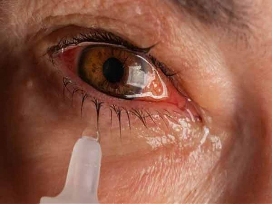 Eye Flu: भारत में आई फ्लू 5 तरह से फैल रहा कंजंक्टिवाइटिस, जानिए लक्षण और बचने के उपाय