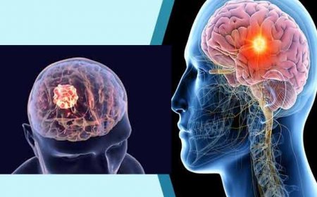 संभल जाइये! बार-बार होने वाला सिरदर्द है खतरे की घंटी: जानिए ब्रेन ट्यूमर के शुरुआती संकेत